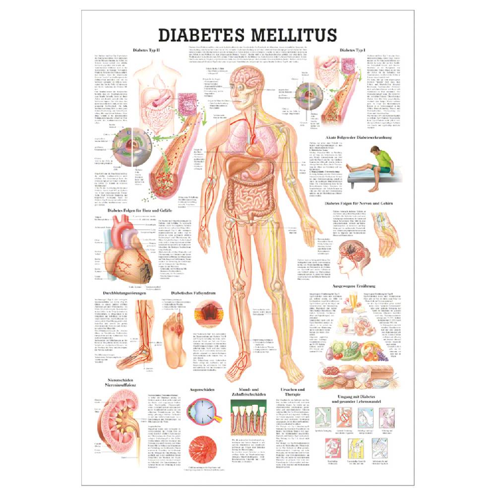 Sport Tec Lehrtafel "Diabetes Mellitus", LxB 100x70 cm